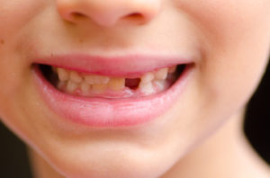 Options To Consider When You Have A Missing Tooth