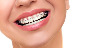 Types of braces and how to choose the right one