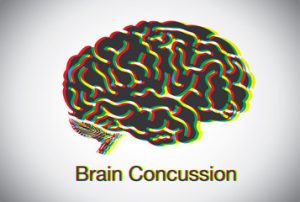 What is a concussion