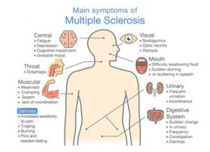 Ways You Can Treat and Lessen the Symptoms of Multiple Sclerosis