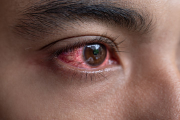 Home Remedies for Red and Itchy Eyes