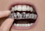 How To Take Care Of Retainers After Braces