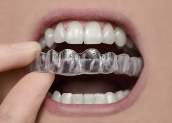 How To Take Care Of Retainers After Braces