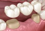 Will A Dental Bridge Last for a Lifetime?