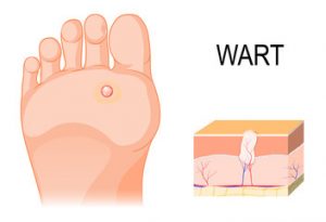 Home Remedies For Treating Warts