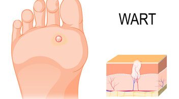 Home Remedies For Treating Warts