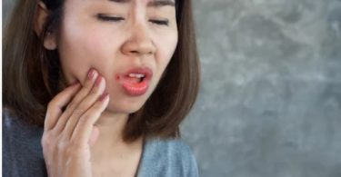 How to Cure Mouth Ulcers Fast Naturally