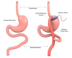 Things To Know About Gastric Bypass Surgery